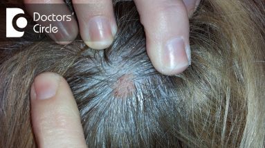 What does small skin colored lump on the scalp indicate? - Dr. Urmila Nischal 8 1682164328 maxresdefault