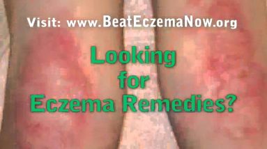 eczema natural remedies 18 1682169810 maxresdefault