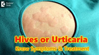 Hives | Urticaria-Causes,Symptoms,Treatment | Skin Rash | Allergy - Dr.Rasya Dixit | Doctors' Circle 4 1682171805 maxresdefault