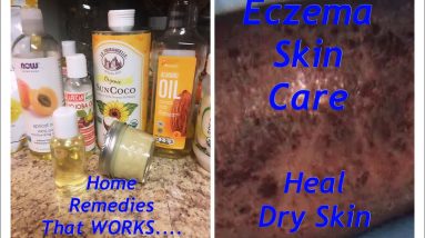 Eczema Skin Care.... How To Heal Dry Skin & Hyperpigmentation on Legs, Face and Body.... 16 1682173811 maxresdefault
