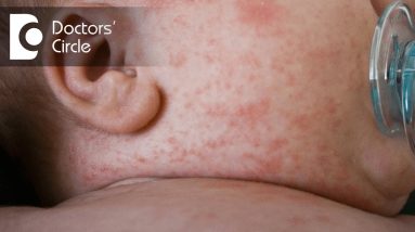 What causes Prickly Heat Rash? - Dr. Rajdeep Mysore 18 1682182818 maxresdefault