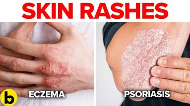 6 Reasons You’re Getting Skin Rashes 4 1682190175 maxresdefault