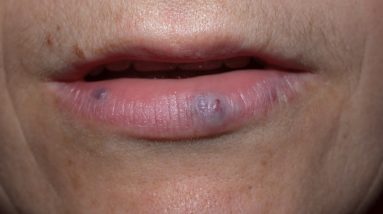 How to get rid of dark spots on lips?-Dr. Rasya Dixit 14 1682190387 maxresdefault