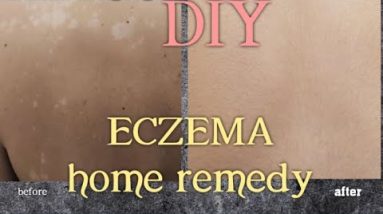 Best way to Get Rid of ECZEMA fast|DIY How to make effective eczema cream to heal eczema quickly 2 1682199198 hqdefault