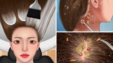 ASMR Removal acne and head lice from at hairline |seborheic dermatitis treatment 8 1682201453 maxresdefault