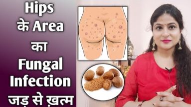 How To Treat Fungal infection Of Private parts | Home Remedy | fungal infection का घरेलू उपाय 8 1682224995 hqdefault
