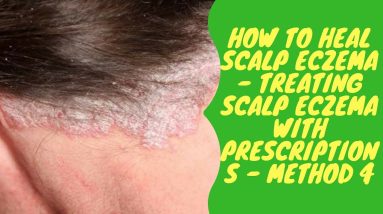 How to Heal Scalp Eczema - Treating Scalp Eczema with Prescriptions - Method 4 6 1682228797 maxresdefault