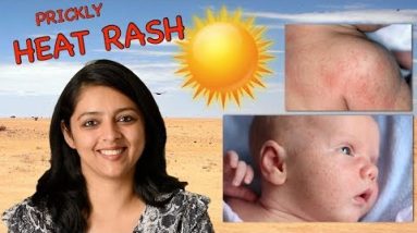 How To Prevent & Treat Prickly Heat Rashes In Babies || Home Remedies 2 1682249885 hqdefault
