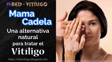 Una alternativa natural para tratar el vitiligo: Mama Cadela 12 1682258314 maxresdefault