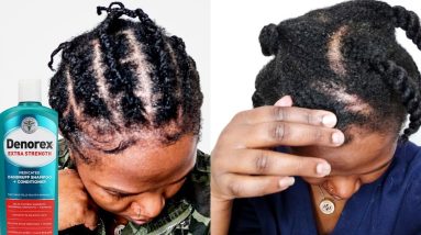 How I Treat My Seborrheic Dermatitis/Eczema using Denorex Shampoo and Bentonite Clay/ Nataya Rhall 10 1682269716 maxresdefault