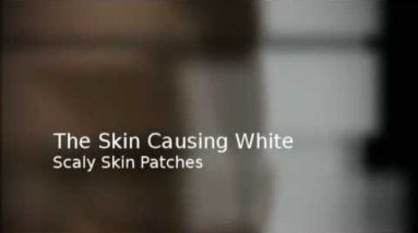Common Causes of Itchy Skin Rashes 8 1682275639 hqdefault