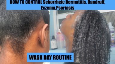 How I control my seborrheic dermatitis, dandruff, psoriasis,eczema- Wash Day Routine| clips included 4 1682280736 maxresdefault