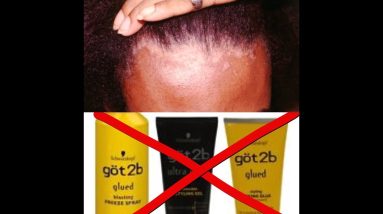 30 Days of Glam NO Got2bGlued! I Have Seborrhoeic Dermatitis 14 1682282630 maxresdefault