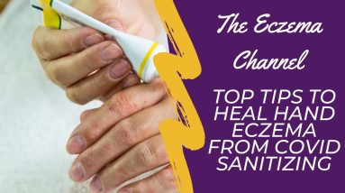 Top Tips to Heal Hand Eczema from Covid Sanitizing 6 1682313683 maxresdefault