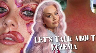 How to treat and deal with Eczema| EYELIDS,FACE, MAKEUP AND AFFORDABLE PRODUCTS 2 1682324761 maxresdefault