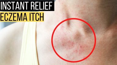 How to Get Instant Relief For Eczema Itch A Permanent Solution 20 1682328395 maxresdefault