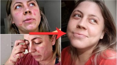 how I cleared my skin + my skincare routine for eczema & acne 16 1682332432 maxresdefault
