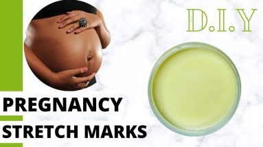 pregnancy cream/How to prevent stretch marks during pregnancy 4 1682335230 maxresdefault