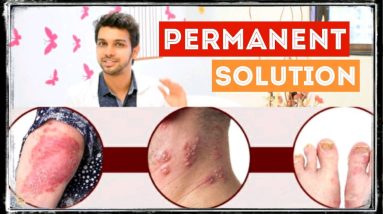 NO MORE FUNGAL INFECTION | HOW TO GET RID OF ANY SKIN INFECTION |BestHacks| Dr. Raj Satpute | JYOVIS 10 1682363527 maxresdefault