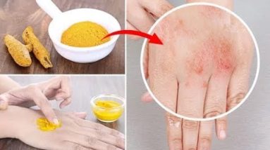 5 Effective Ways to Use Turmeric for Eczema and Itching 18 1682368780 hqdefault