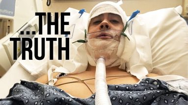 what they DON'T tell you about CORRECTIVE JAW SURGERY | JairWoo 16 1682372500 maxresdefault