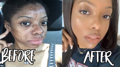 AFRICAN BLACK SOAP DIY LIQUID | HOW I CLEARED MY ACNE and ECZEMA 10 1682380595 maxresdefault