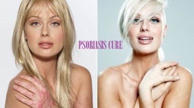 Natural Psoriasis Cure: Remedies for Psoriasis Home Treatment 16 1682389129 hqdefault