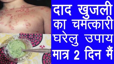 Home Remedies For Ringworm | How To Cure Ringworm In 2 Days 14 1682392763 maxresdefault