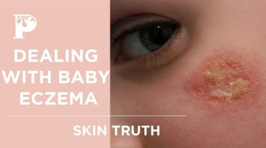 IS THERE A PERMANENT SOLUTION FOR BABY ECZEMA? 2 1682395302 maxresdefault