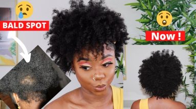 How To Get Rid Of A BALD SPOT | DEALING WITH ECZEMA AND SCALP ISSUES | Chev B. 12 1682412293 maxresdefault