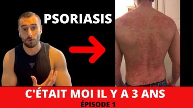 PSORIASIS : Quelles Vraies Solutions pour enfin le Soigner et s’en Sortir ? (Du début à Ma Guérison) 10 1682416007 maxresdefault