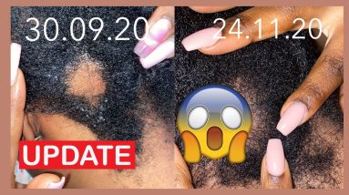Bald Spot Update. New Growth or Stuck? Growth Treatment For Bald spots 6 1682518077 maxresdefault