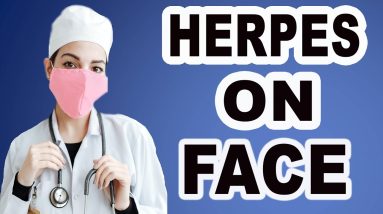 herpes on face 8 1682551288 maxresdefault