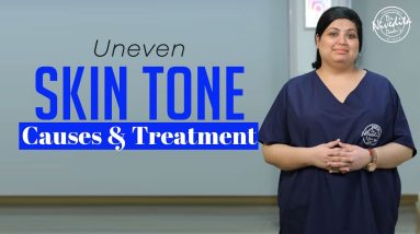 Patchy or uneven skin tone | Causes, remedies, medications and treatments 12 1682591973 maxresdefault