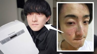 持病の新薬治療を始めました。副作用について。【デュピクセント/ 年額50万円 / アトピー性皮膚炎】 4 1682649100 hqdefault