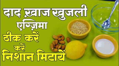 दाद खाज खुजली Eczema Ringworm को ख़त्म करें और निशान मिटायें | Eczema, Itching Problem 2 1682728200 maxresdefault