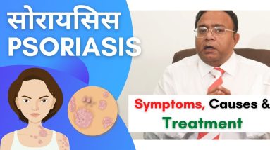 Psoriasis - #सोरायसिस Treatment | Symptoms, Cause and Treatment | THIS IS ONLY SOLUTION in Hindi 4 1682768680 maxresdefault