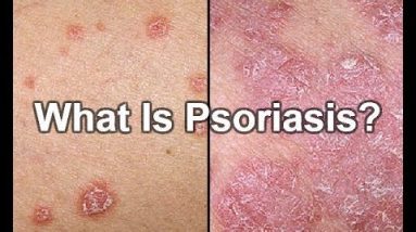 What Is Psoriasis | Symptoms | Treatments | Causes | Pictures | Types 12 1682798108 hqdefault