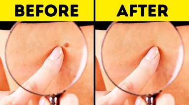 10 Effective Ways to Remove Skin Tags Naturally 18 1682872626 maxresdefault