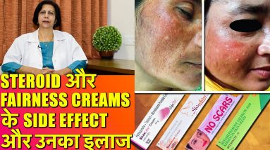 Steroid और Fairness Creams के Side Effects और उनका इलाज 16 1682872730 maxresdefault