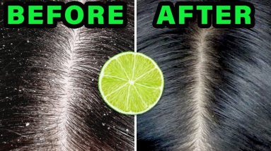 How to REMOVE DANDRUFF in 10 minutes USING LEMON JUICE! 10 1682879978 maxresdefault