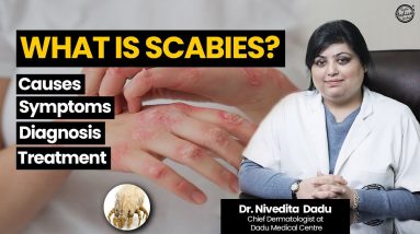 WHAT IS SCABIES? Causes, Symptoms, Diagnosis & Treatment | Dr. Nivedita Dadu 8 1682902363 maxresdefault