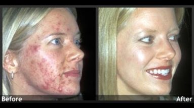 How To Get Rid Of Acne.Acne Home Remedies.Natural Cures For Acne.Natural Acne Treatment 18 1682921018 hqdefault