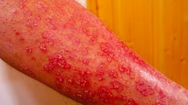 Home Remedies for Inverse Psoriasis Best treatment for psoriasis 14 1682928371 maxresdefault