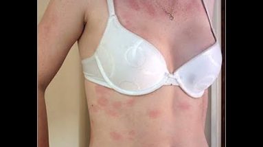 Scalp Ringworm Symptoms, Ringworm Medicine For Humans, How To Get Rid Of Ringworm On Face, Ringworm 10 1682935845 hqdefault