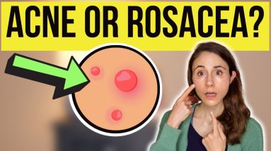 IS IT ACNE OR ROSACEA? 😳 Dermatologist @DrDrayzday 18 1682972723 maxresdefault