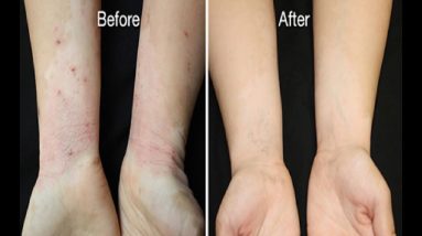 10 Easy Home Remedies for Rashes | oatmeal bath diaper rash | home remedies for thigh chafing 10 1683017059 maxresdefault