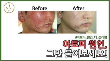 #20 아토피(주사피부염, 지루성피부염 다 동일)의 원인 좀 그만물어보세요..(열, 습열X) 8 1683057709 maxresdefault