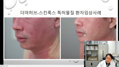 아주 운좋은 '지루성피부염' 극복기? 2 1683068723 maxresdefault