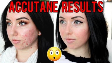 MY ACCUTANE JOURNEY 6 MONTH RESULTS Before & After, Side Effects, Would I Do it Again?... 14 1683375461 maxresdefault